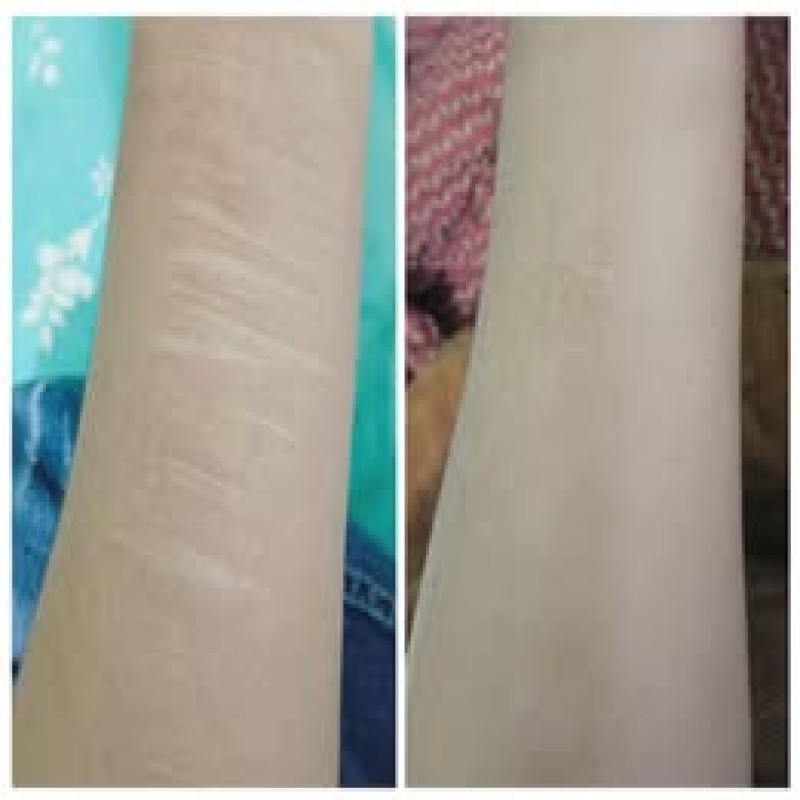 Anti-Stretch Mark Miracle Stick